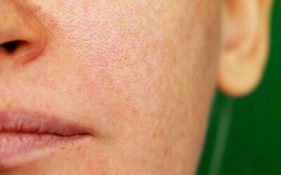 Große Poren sichtbar verfeinern – 10 effektive Tipps vom Studio Baha